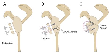 Jcm Free Full Text Acromion And Distal Clavicle Grafts For