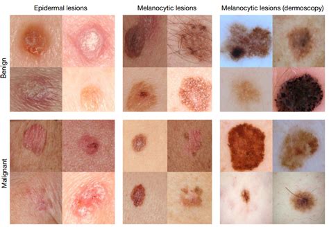 Deep Learning Algorithm Diagnoses Skin Cancer As Well As Seasoned