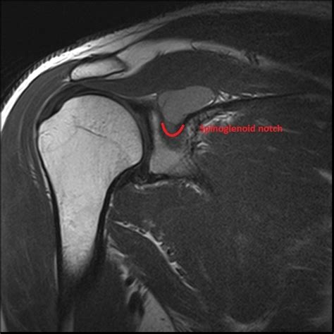 Suprascapular Notch Mri