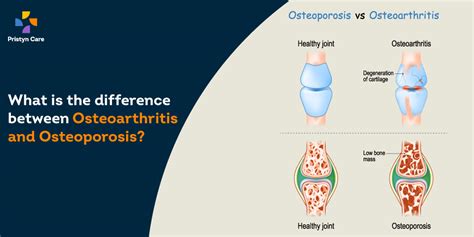 What Is The Difference Between Osteoporosis And Osteoarthritis