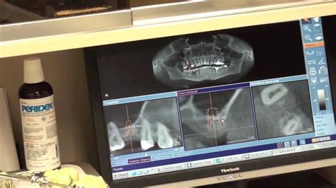 Explicit Internal Sinus Lift Osteotome Technique Dental Surgery