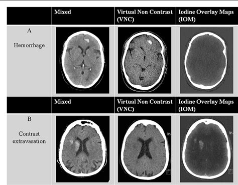 The Role Of Dual Energy Ct In Differentiating Between Brain Haemorrhage