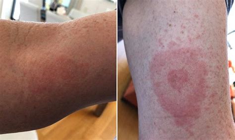 Lyme Disease Hotspot Is Declared After Mans Tick Bite Blows Up Into