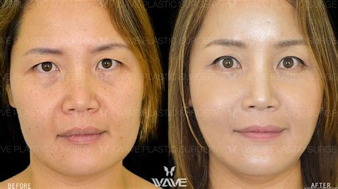 Facelift Surgery And Procedures Wave Plastic Surgery