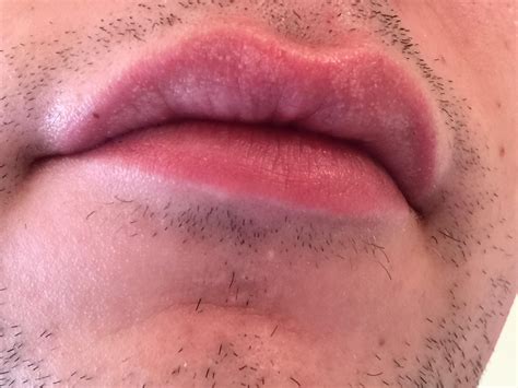 What Is Going On With My Upper Lip White Patches Mild Burning When