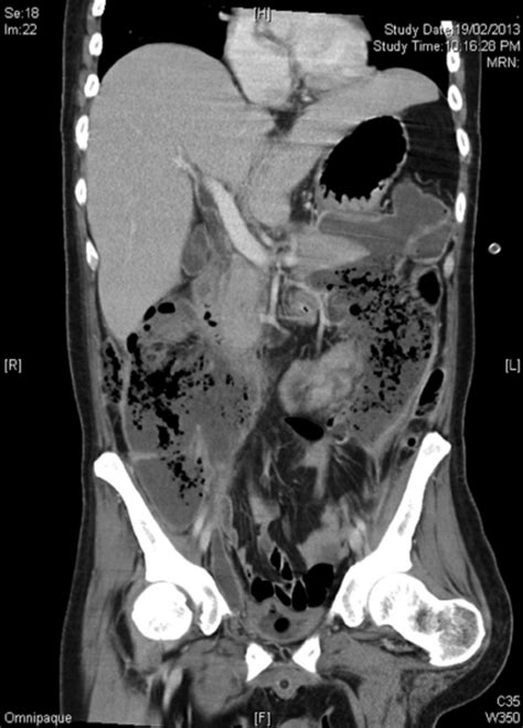 Ct Scan Showing Gas Formation And Bilateral Retroperitoneal
