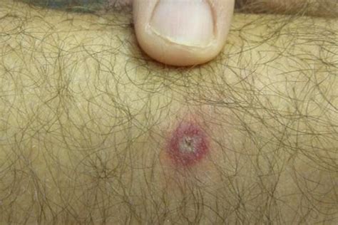Tick Bite Pictures Symptoms What Does A Tick Bite Look Like Lupon Gov Ph