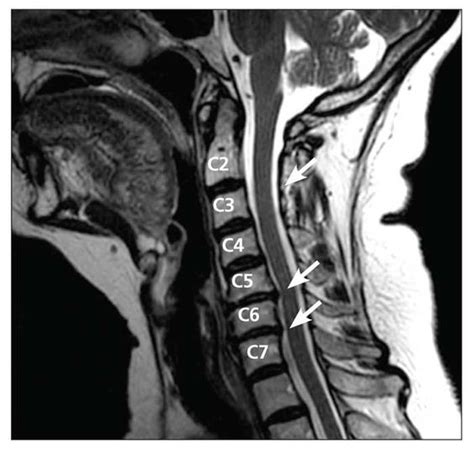 Cervical Spine Mri Bulged Disc C3 4 C4 5 And C5 6 Cervical Disk
