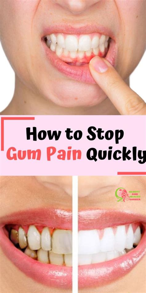 The Novices Guide To Taking Care Of Oral Hygiene Swollen Gums Remedy