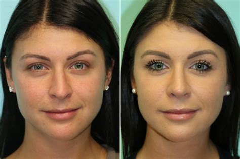 Rhinoplasty Photos Chevy Chase Md Patient 20218