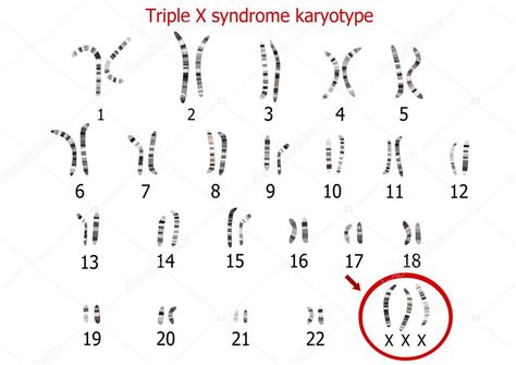 Sintomas De Trissomia X