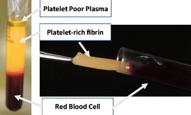 Platelet Rich Fibrin Collected From The Middle Of A Tube Containing