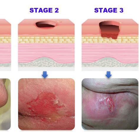 Bar Chart Showing The Distribution Of Pressure Ulcer Stages And Download Scientific Diagram