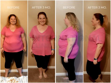 Gastric Sleeve Before And After 3 Months Results Pictures And Videos 2023 International Clinics