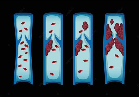 Different Stages Of Blood Clot In Human Blood Clot Science Clip Vector