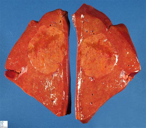 focal nodular hyperplasia - Humpath.com - Human pathology