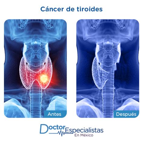 Oncologos Para Cirugia De Cancer De Tiroides Doctor Especialistas
