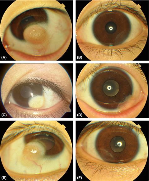 Surgical Management Of Limbal Dermoids 10‐year Review Yao 2017