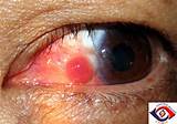 Eye Granuloma Treatment Images