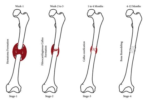 The Stages Of Healing Of Bone Fracture Download Scientific Diagram