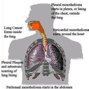 We did not find results for: asbestos attorney ohio: MESOTHELIOMA DEFINITION