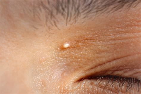 Milia Spots Causes And Treatment Este
