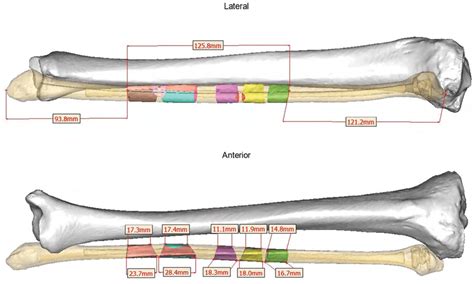Patient Specific Left Fibula Graft 5 Segments Download Scientific