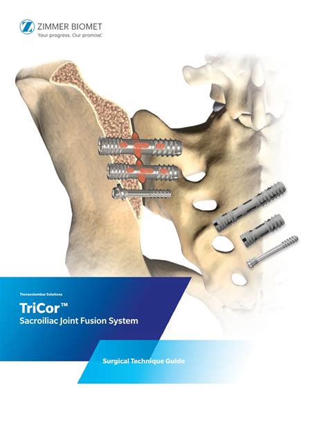 Tricor™ Sacroiliac Joint Fusion System Surgical Technique Guide Docslib