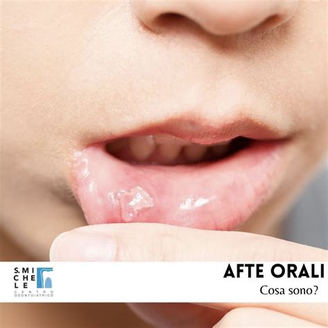 Afte Orali Cosa Sono Centro Odontoiatrico S Michele Dentista