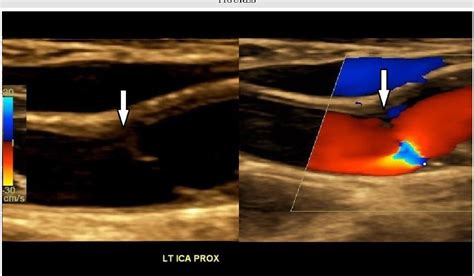 Figure From Internal Carotid Artery Web Doppler Ultrasound With Ct