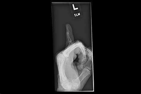 Ortho Dx Swelling And Deformity Of The Small Finger Clinical Advisor