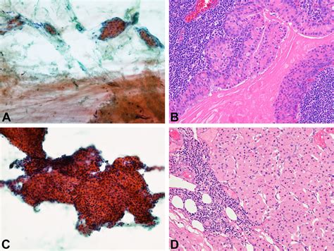 Subtyping Salivary Gland Neoplasm Of Uncertain Malignant Potential