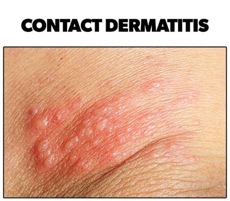 What Does A Contact Dermatitis Rash Look Like