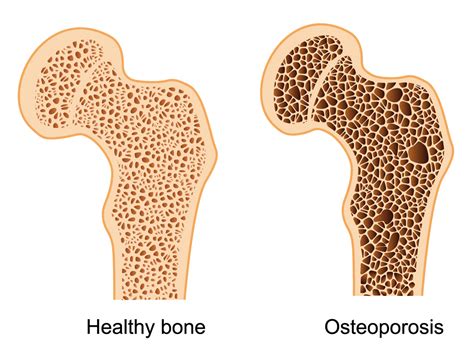 Osteoporosis And Bone Health