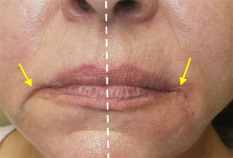 Corner Of The Mouth Filler Model Treatment Derma Models