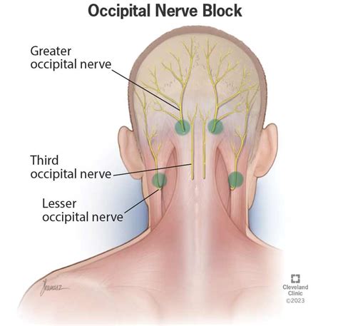 Occipital Neuralgia Nerve Block Injection Illustration Essay My Xxx
