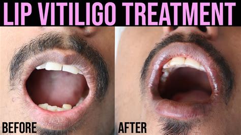 Lip Vitiligo Lip Vitiligo Treatment Lip Leucoderma Best Treatment