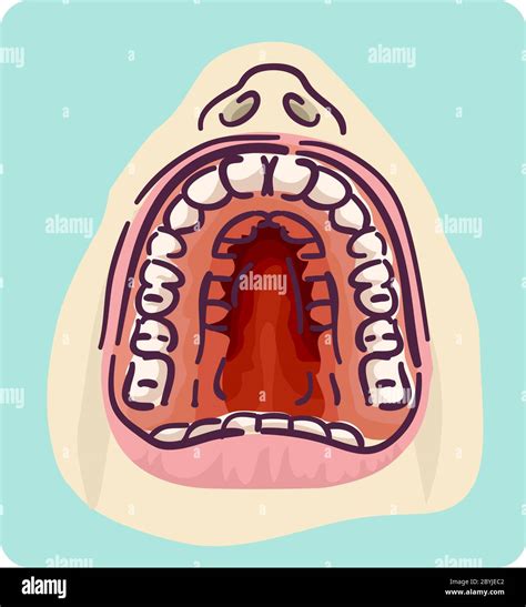 Illustration Of A Wide Opened Mouth With High Arched Palate And Crowded