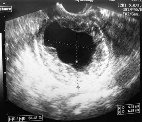 The Sonographic View Of The Right Adnexal Mass Download Scientific