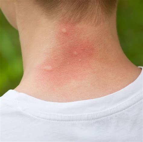 Do You Have A Mosquito Bite Allergy The Most Common Reactions Explained Keep Women Healthy