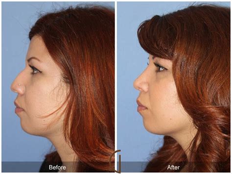 Female Rhinoplasty Before And After Photos From Dr Kevin Sadati