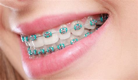 Are Braces Only About Aesthetics Central Coast Orthodontics