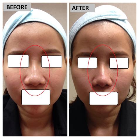 Nose Tip Refinement Filler Procedure Kl Aesthetic