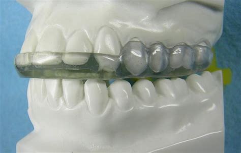 Goldilocks Splint Accutech Orthodontic Laboratory Products