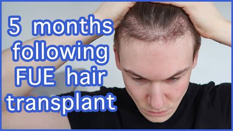 FUE Hair Transplant Month 5 FAQ Surgery Growth Before After