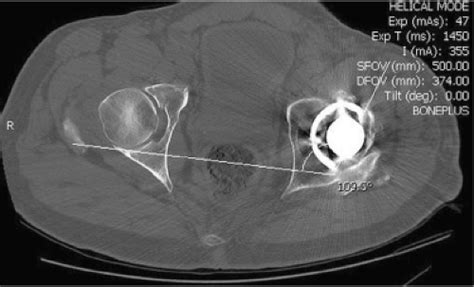 Cementless Acetabular Components For Revision Total Hip Arthroplasty