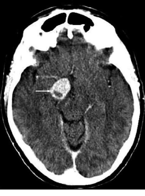 Ct Scan Taken 6 Days After The Onset Of Symptoms Demonstrating An