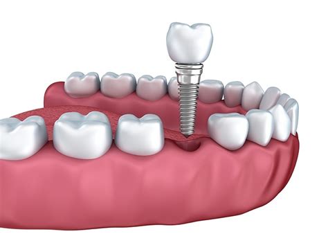 The cost of dental implants depends on many factors, including the type of implantation, the dentist performing the procedure, the location where the placement surgery is performed, the material used and the amount of dental insurance you have. How Much Do Dental Implants Cost in Thailand? - Dental ...