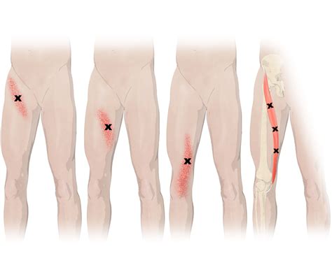 A large muscle originating in the anterior superior iliac spine and inserting in the tibia; The Sartorius Muscle | Sartorius muscle, Muscle, Tight hip ...