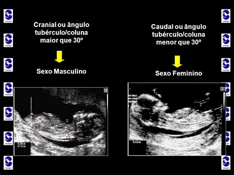 Quem Define O Sexo Do Bebê
